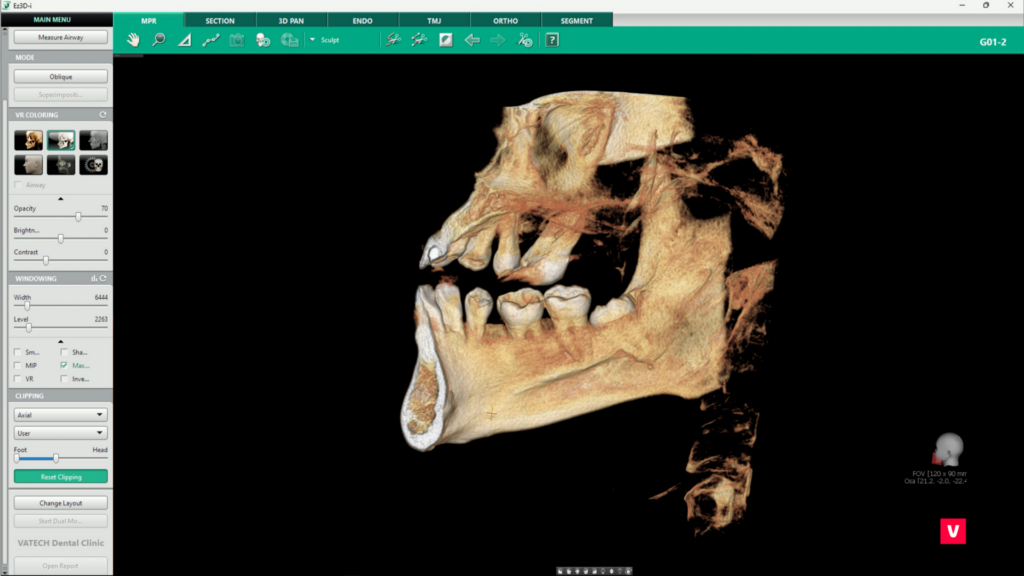 Tooth in Maxila CBCT image / Clipping