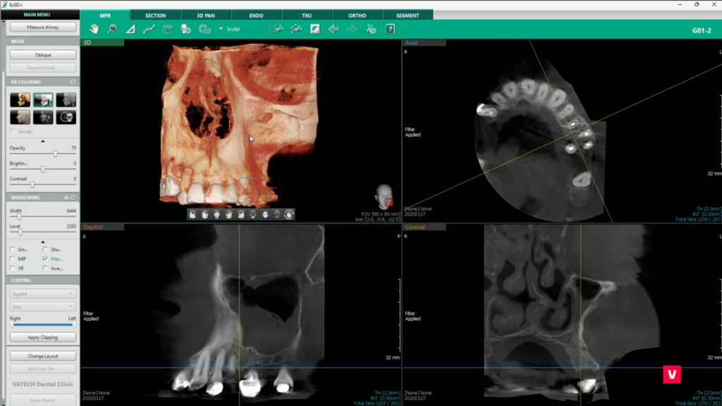 Finding in Maxilla 3D image