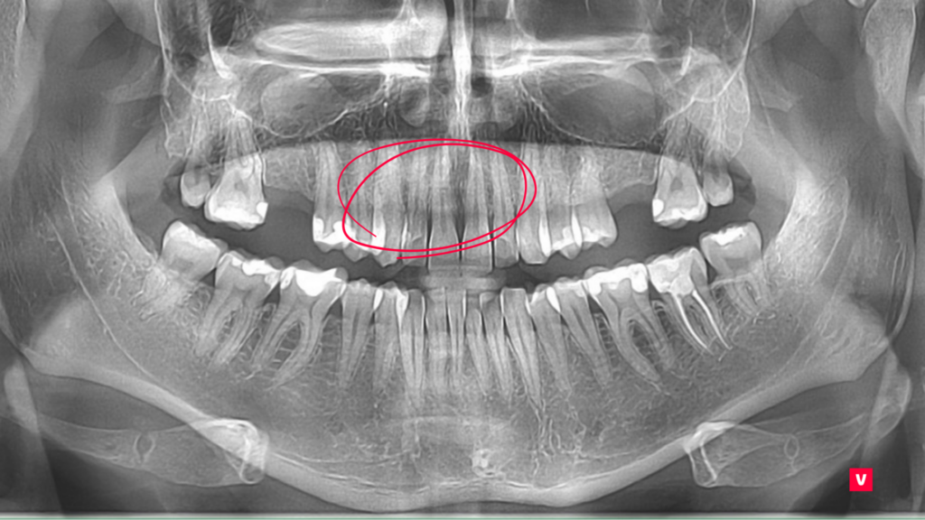 Tooth 11 Fracture