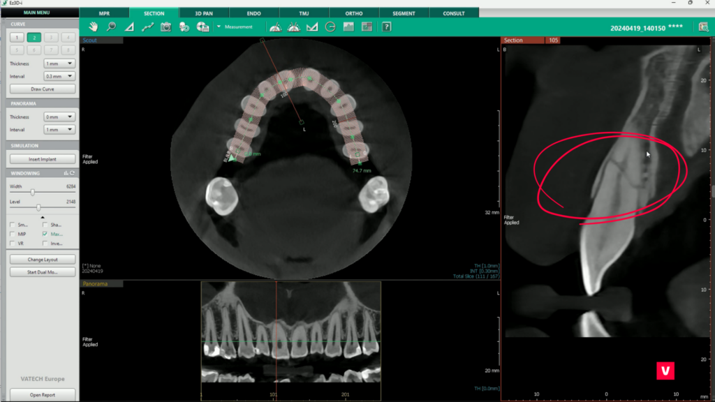 Tooth 11 Fracture CBCT Image