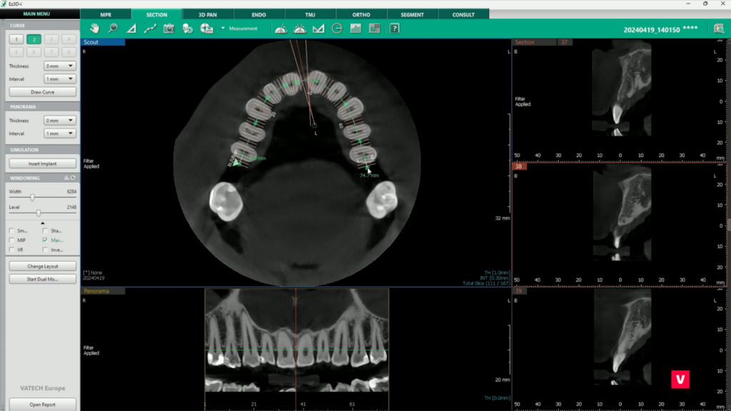 Tooth 11 Fracture CBCT Image