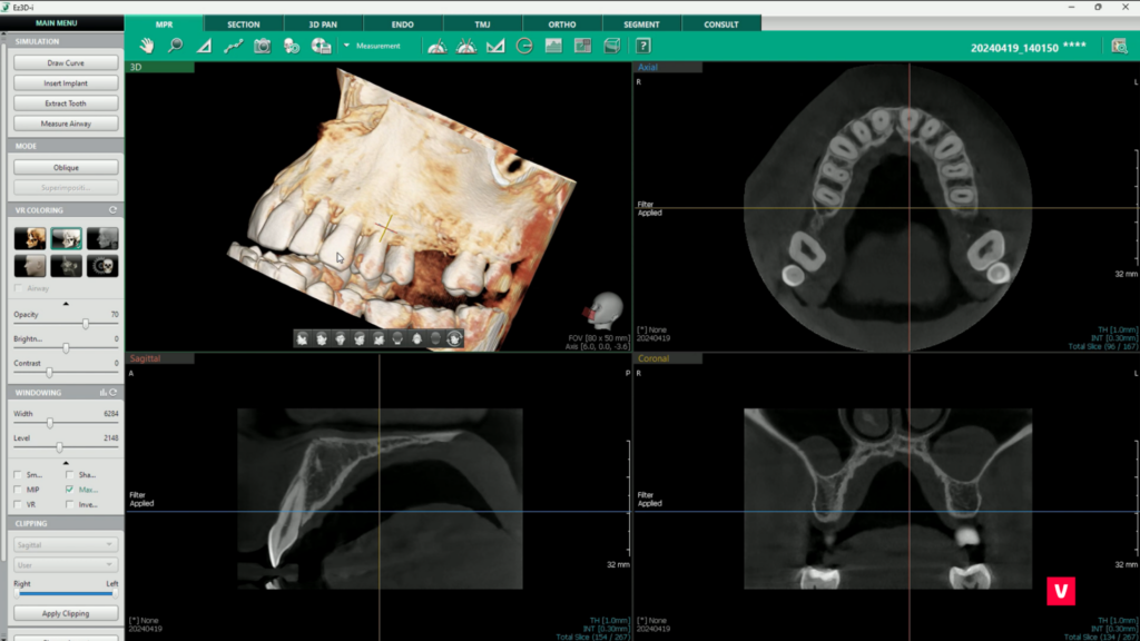 Tooth 11 Fracture CBCT Image