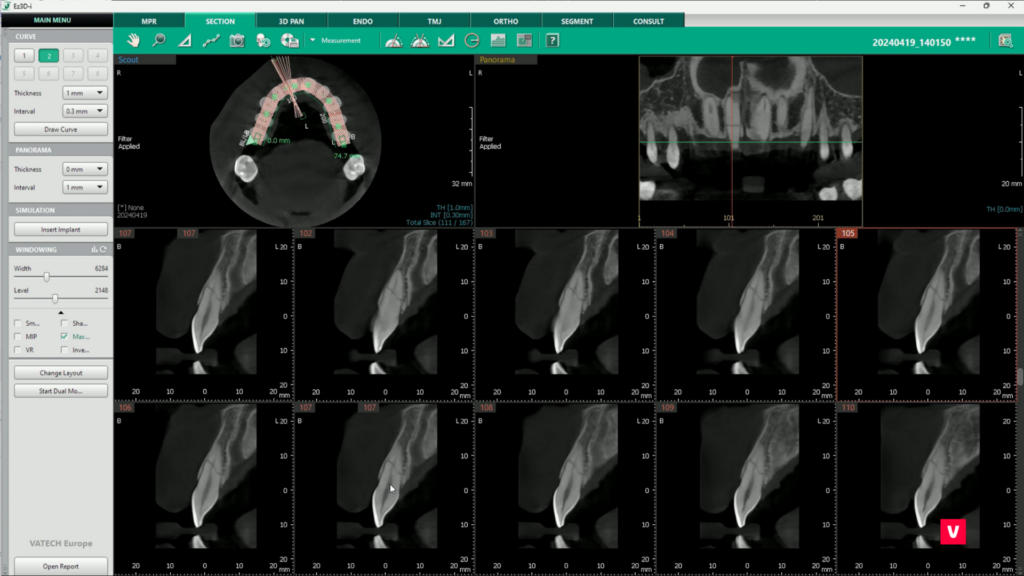 Tooth 11 Fracture CBCT Image