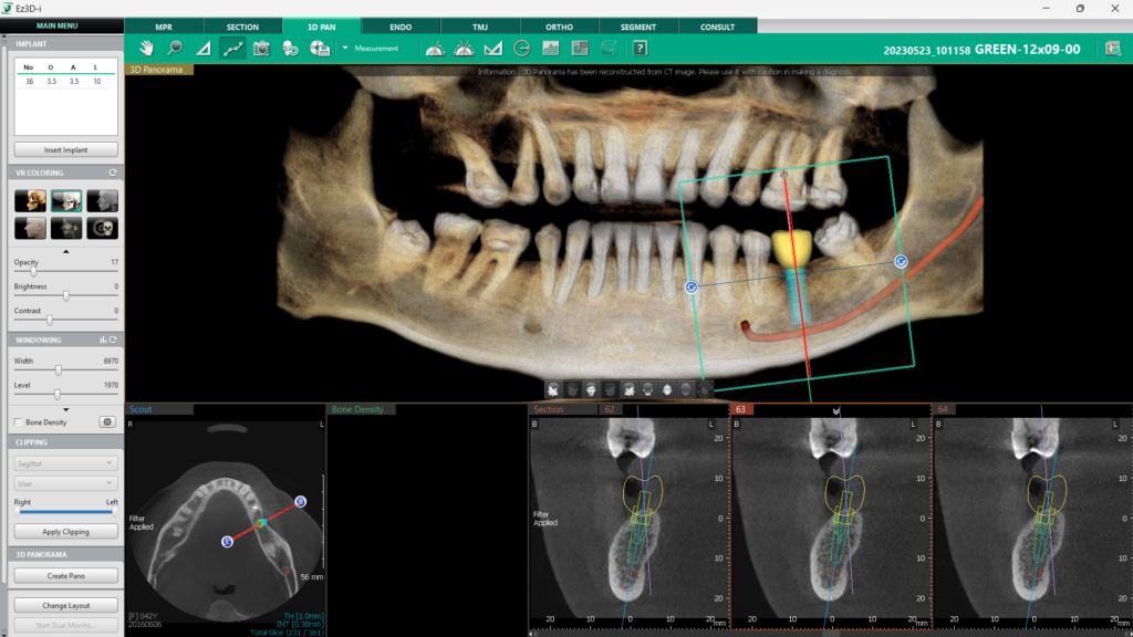 Mandibular Canal Drawing