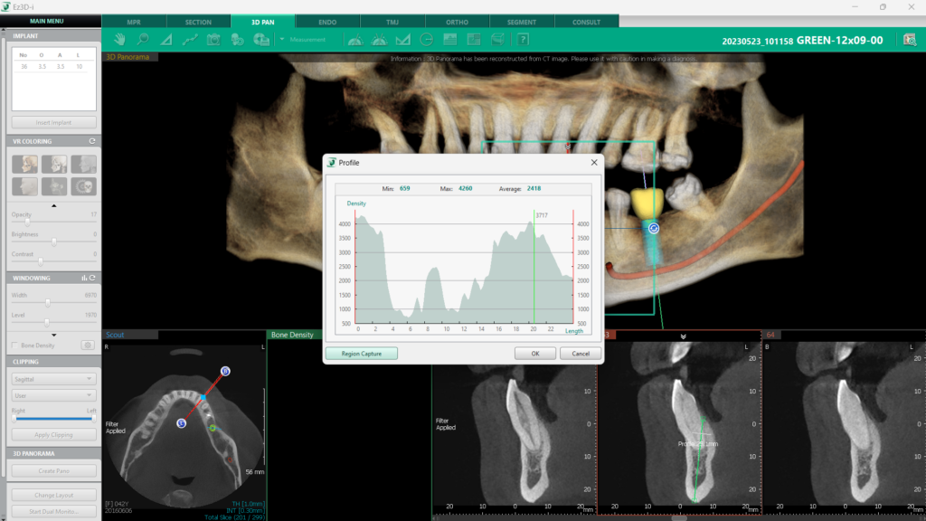 Bone Density Graph