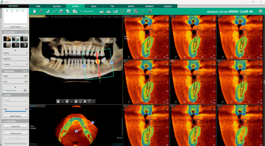 Bone Density Overlay